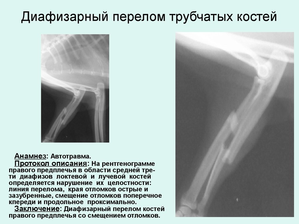 Образец описания рентгенограммы перелома