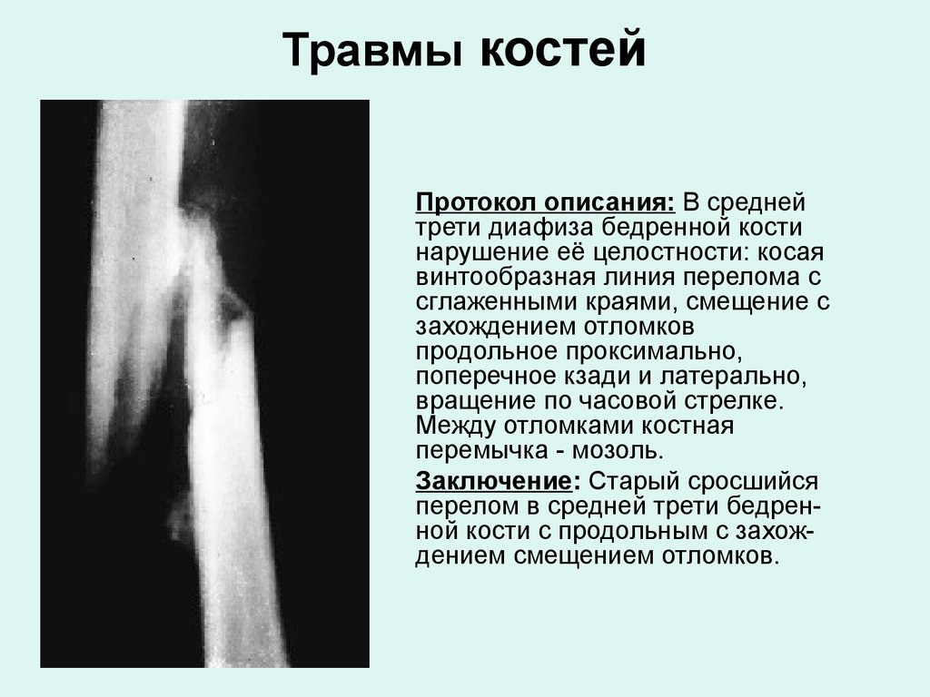 Содержание костей. Описание рентгенограммы перелома бедренной кости. Перелом бедра описание рентгенограммы. Перелом бедра рентген описание. Рентген протокол перелома.