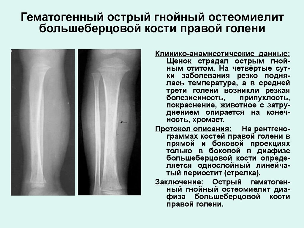 Гематогенный острый гнойный остеомиелит большеберцовой кости правой голени