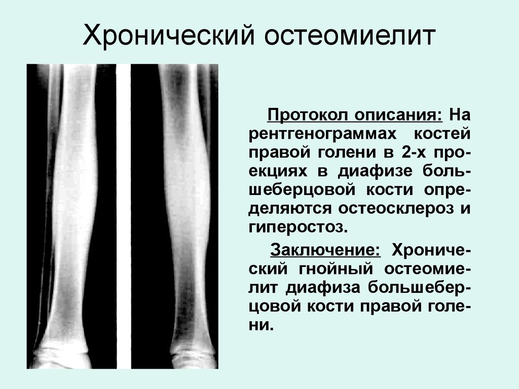 Периостит голени. Остеомиелит большеберцовой кости рентген. Хронический остеомиелит большеберцовой кости кт. Хронический остеомиелит бедренной кости. Остеомиелит диафиза бедренной кости рентген.