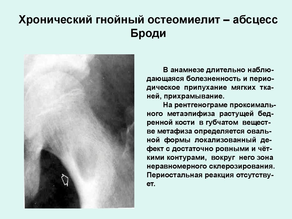 Хронический гнойный остеомиелит – абсцесс Броди