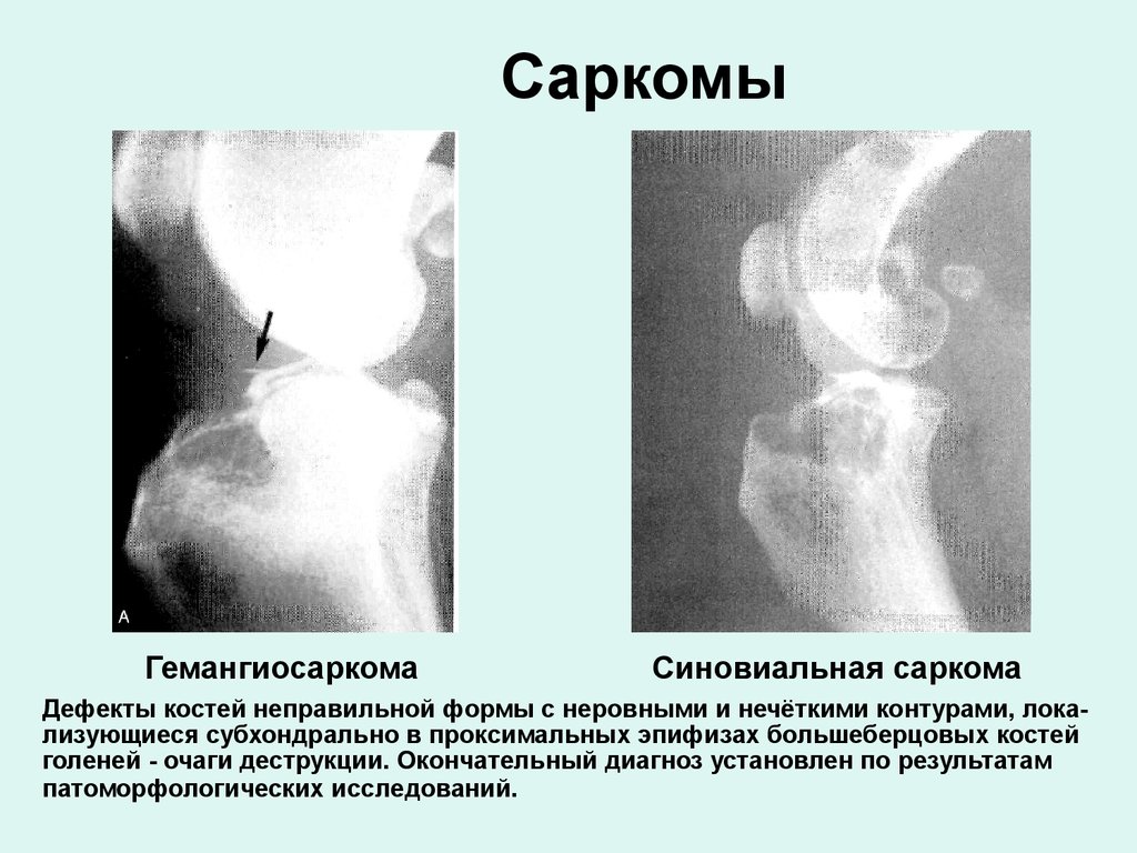 Саркомы