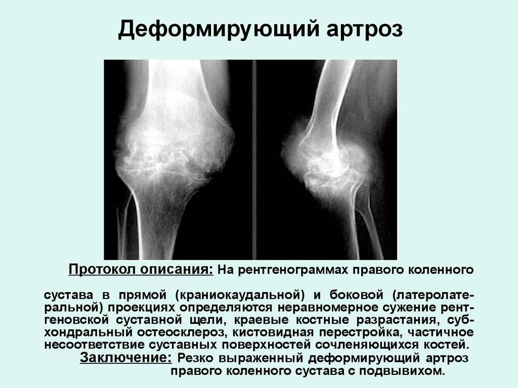 Протокол описания: На рентгенограммах правого коленного сустава в прямой (краниокаудальной) и боковой (латеролате-ральной) проекциях опре