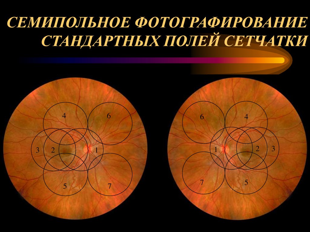 СЕМИПОЛЬНОЕ ФОТОГРАФИРОВАНИЕ СТАНДАРТНЫХ ПОЛЕЙ СЕТЧАТКИ