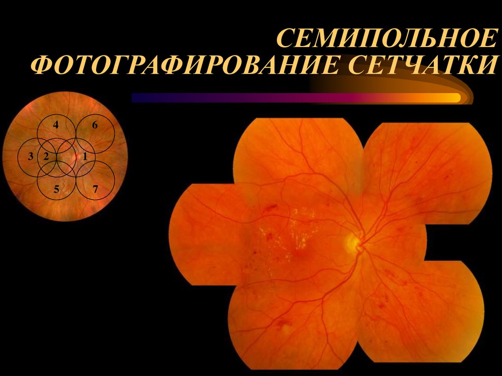 СЕМИПОЛЬНОЕ ФОТОГРАФИРОВАНИЕ СЕТЧАТКИ