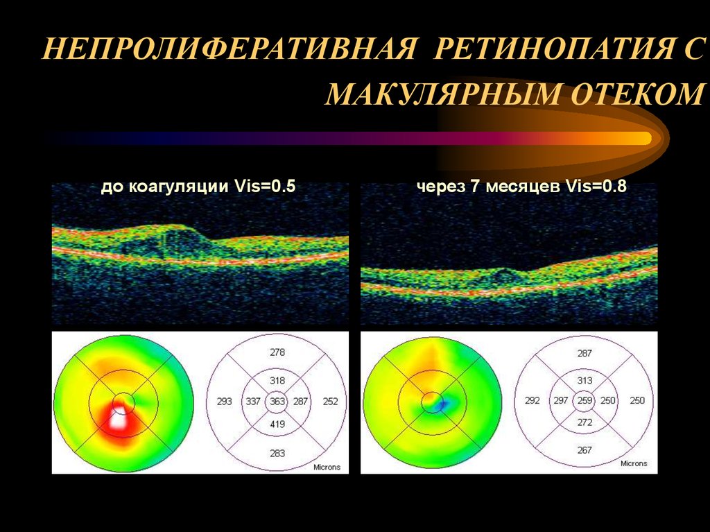 НЕПРОЛИФЕРАТИВНАЯ РЕТИНОПАТИЯ С МАКУЛЯРНЫМ ОТЕКОМ