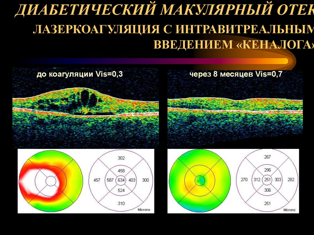 ДИАБЕТИЧЕСКИЙ МАКУЛЯРНЫЙ ОТЕК ЛАЗЕРКОАГУЛЯЦИЯ С ИНТРАВИТРЕАЛЬНЫМ ВВЕДЕНИЕМ «КЕНАЛОГА»