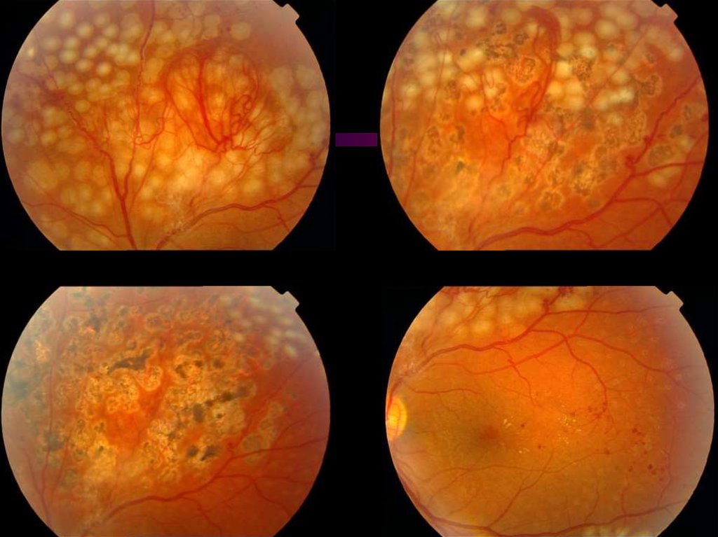 Сетчатки обоих глаз. Диабетическая ретинопатия глазное дно. Пролиферативная диабетическая ретинопатия. Пролиферативная диабет ретинопатия. Диабетическая микроангиопатия (ретинопатия.