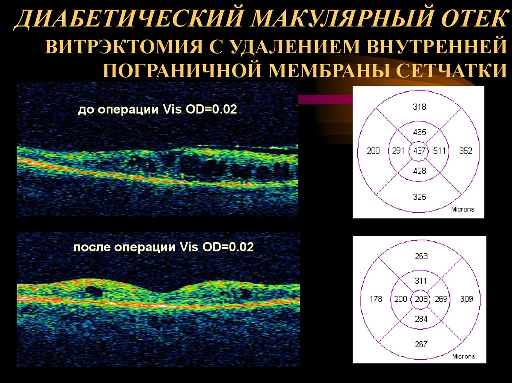 ДИАБЕТИЧЕСКИЙ МАКУЛЯРНЫЙ ОТЕК ВИТРЭКТОМИЯ С УДАЛЕНИЕМ ВНУТРЕННЕЙ ПОГРАНИЧНОЙ МЕМБРАНЫ СЕТЧАТКИ