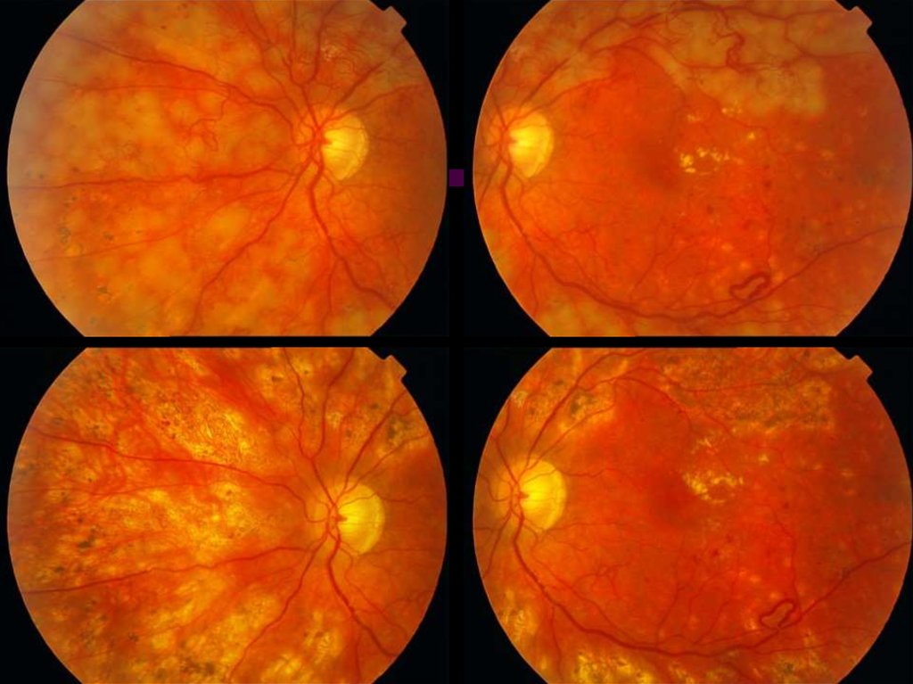 Гипертоническая ангиопатия обоих глаз. Диабетическая ретинопатия глазное дно. Препролиферативная диабетическая ретинопатия глазное дно. Препролиферативная диабетическая ретинопатия клиника. Диабетическая ретинопатия глиоз.