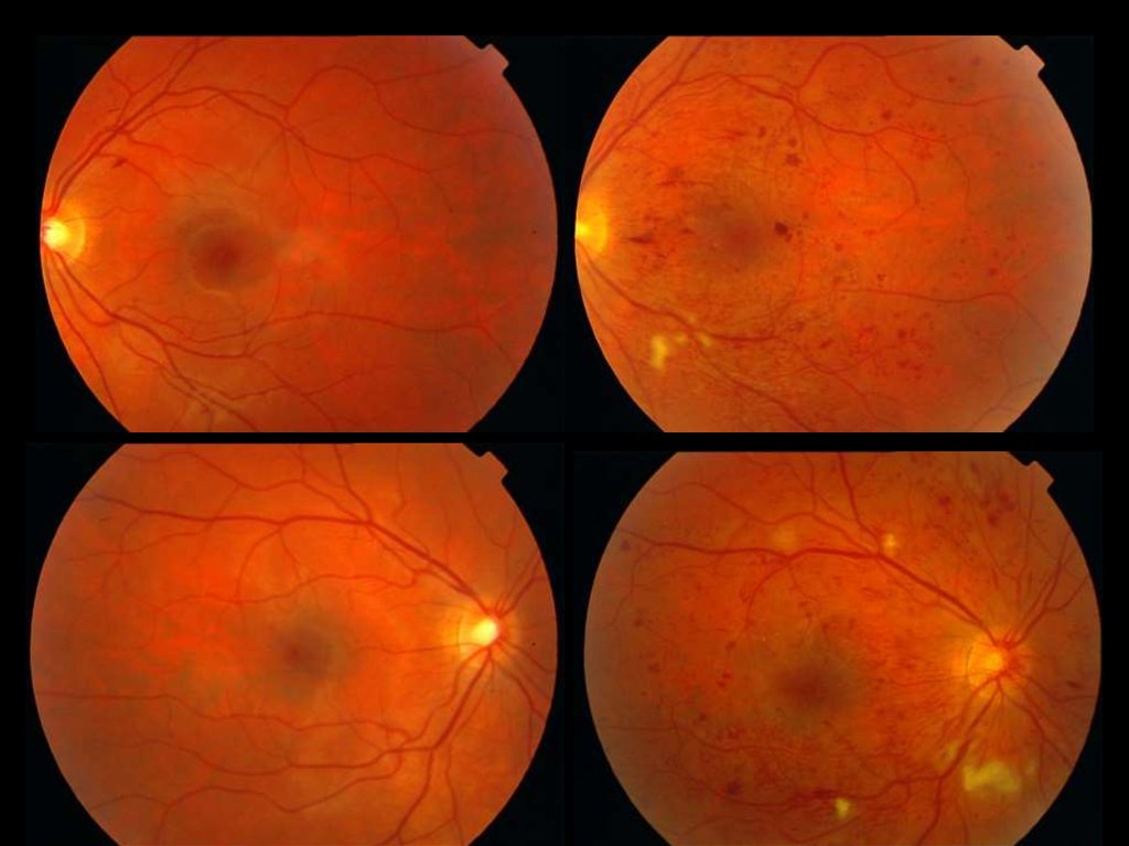 Гипертоническая ретинопатия стадии и клиническая картина