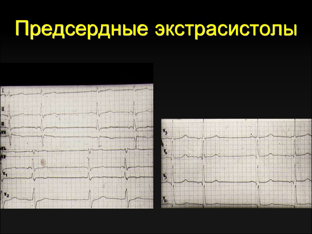 Аберрантные экстрасистолы. Предсердные экстрасистолы на ЭКГ. Монотопные предсердные экстрасистолы. Предсердная экстрасистолия на ЭКГ. Средне предсердная экстрасистолия.