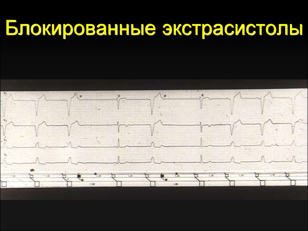 Блокированные экстрасистолы