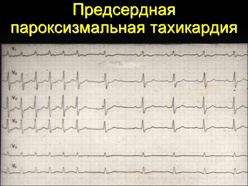 Тахикардия на экг. ЭКГ-критерии пароксизмальной предсердной тахикардии. Предсердная пароксизмальная тахикардия на ЭКГ. Предсердная пароксизмальная тахикардия на ЭКГ признаки. Пароксизмальная тахикардия ЭКГ.