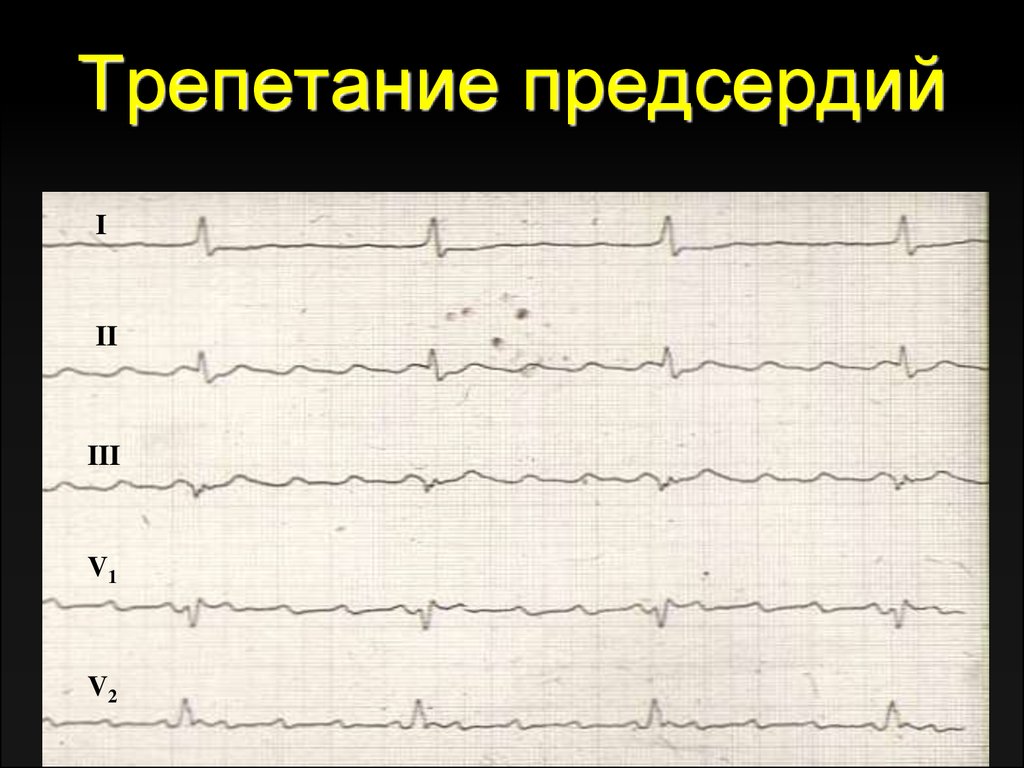 Типы трепетания предсердий. Трепетание предсердий 3 к 1 на ЭКГ. Трепетание предсердий 1 к 1 на ЭКГ. Правильная форма трепетания предсердий на ЭКГ. Трепетание предсердий 2:1.