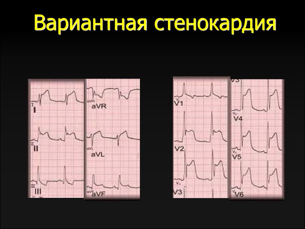 Стенокардия на экг