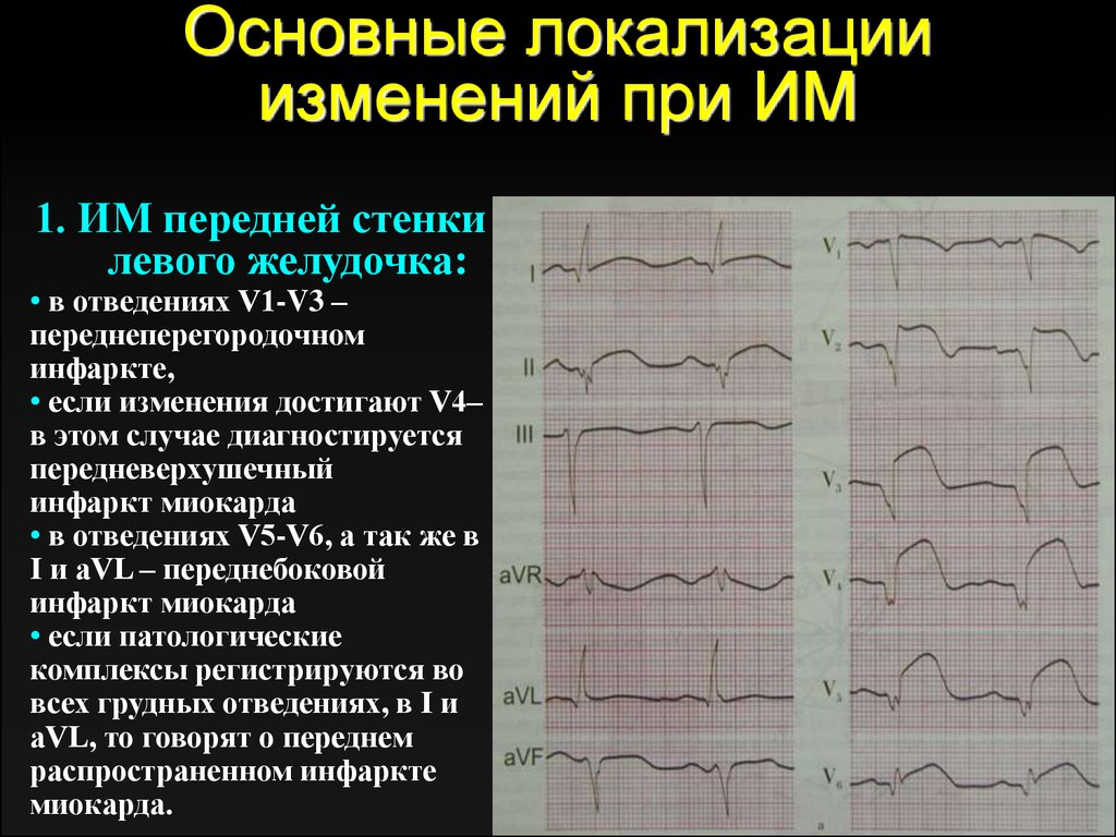 Изменения миокарда левого желудочка сердца. ЭКГ инфаркт передней перегородки. Инфаркт миокарда передней стенки ЭКГ. ЭКГ ОИМ нижней стенки лж. Инфаркт миокарда передней перегородки на ЭКГ.