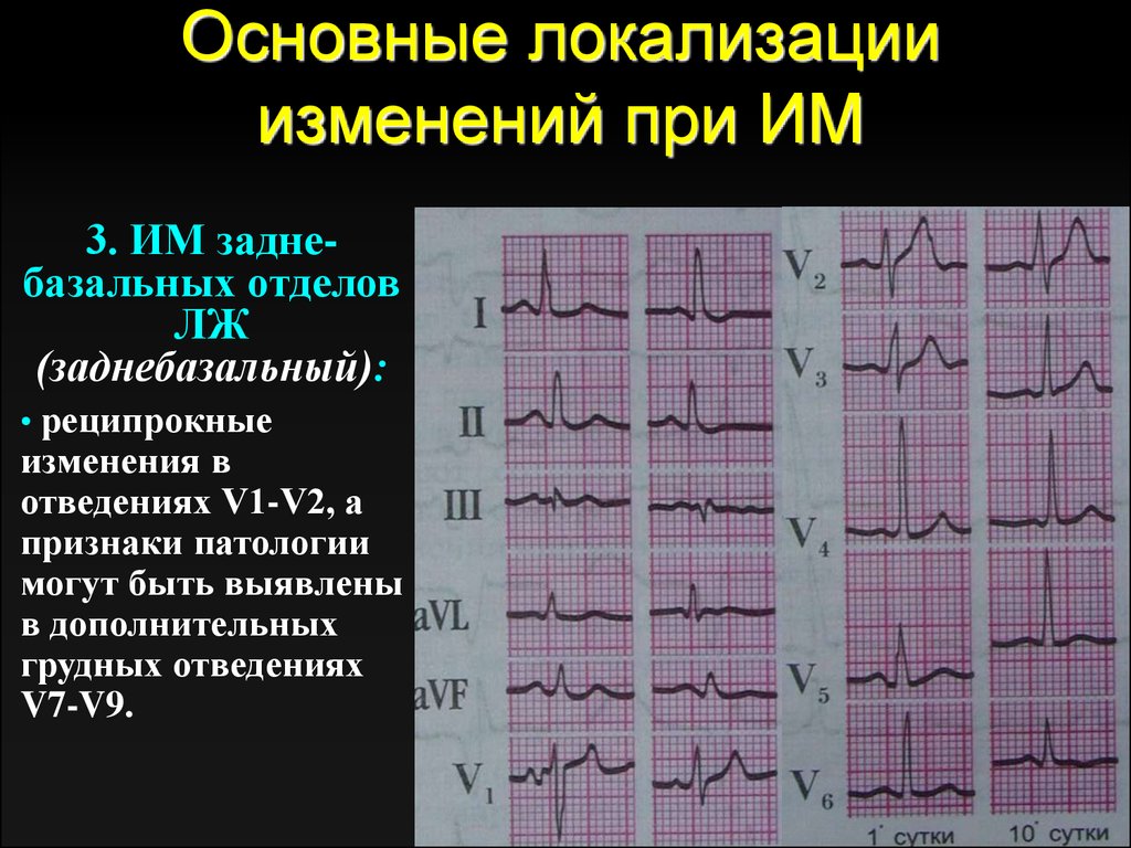 Изменения боковых отделов. Инфаркт миокарда ЭКГ грудные отведения. Аномалия St-t на ЭКГ. Заднедиафрагмальный инфаркт миокарда ЭКГ. ЭКГ при заднебазальном инфаркте.