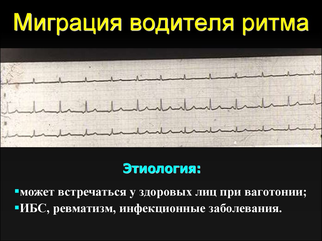 Водитель ритма. Миграция предсердного водителя ритма. Миграция суправентрикулярного ритма на ЭКГ. Миграция наджелудочкового водителя ритма. Миграция суправентрикулярного водителя ритма на ЭКГ.