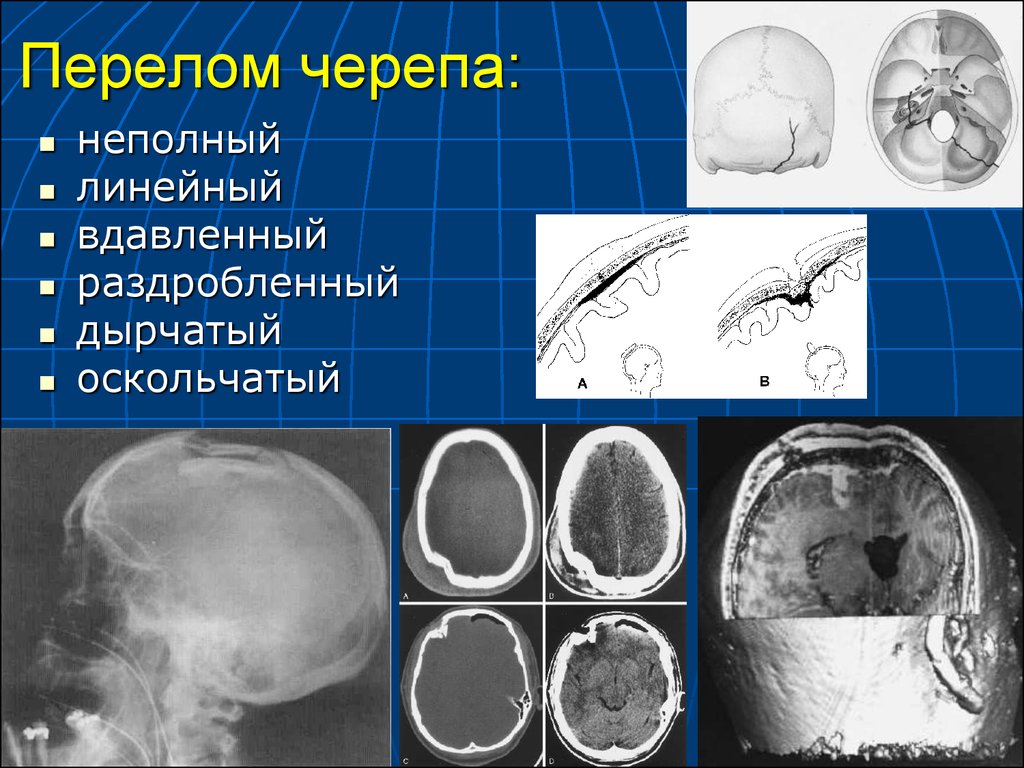 Линейная трещина