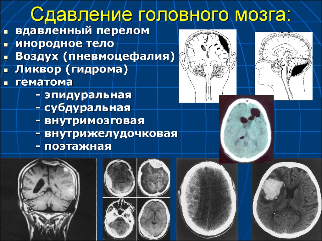Сдавление мозга признаки. Инфратенториальная субдуральная гематома. Сдавление головного мозга. Давление головного мозга. Сдавление головного мозга внутричерепными гематомами.