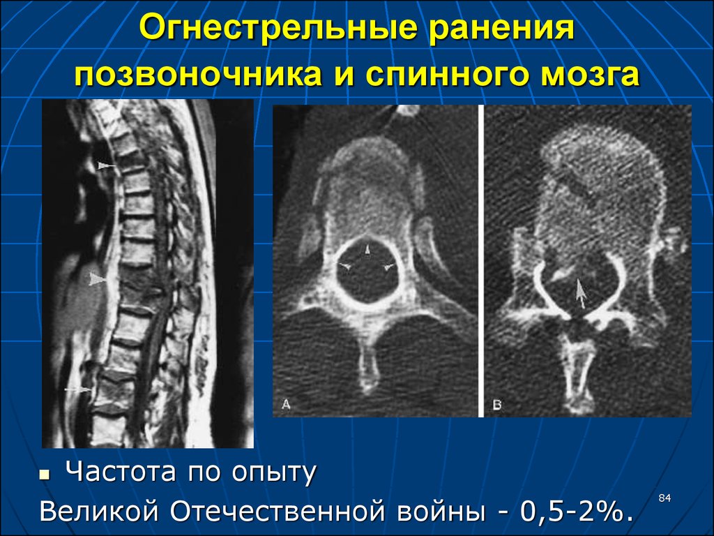 Сотрясение позвоночника