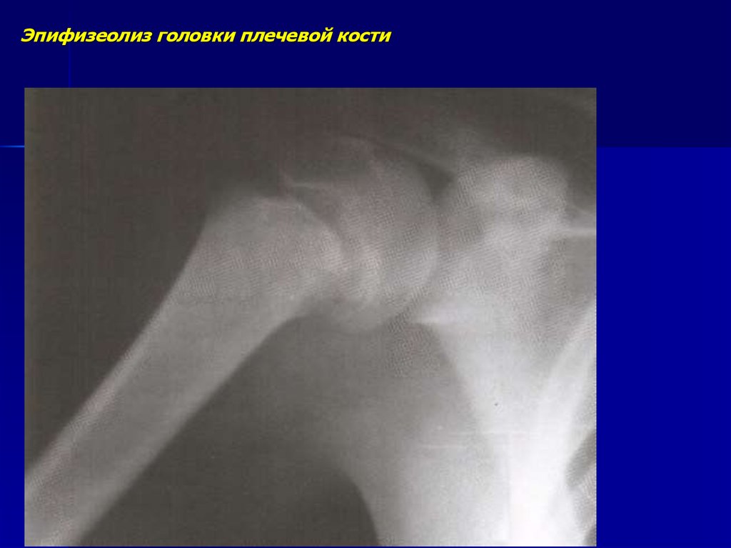 Эпифизеолиз. Остеоэпифизеолиз головки плечевой кости. Эпифизеолиз (перелом Салтера-Харриса);. Эпифизеолиз проксимального отдела плечевой кости. Травматический эпифизеолиз плечевой кости у новорожденных.