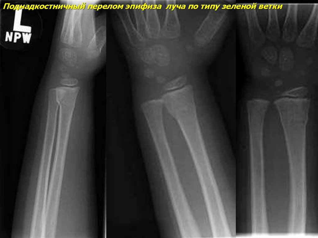 Сколько срастается предплечье. Поднадкостничный перелом лучевой кости рентген. Эпифизеолиз лучевой кости рентген. Поднадкостничный перелом рентген. Поднадкостничный перелом лучевой кости у детей.