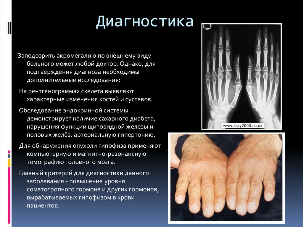 Акромегалия и гигантизм презентация