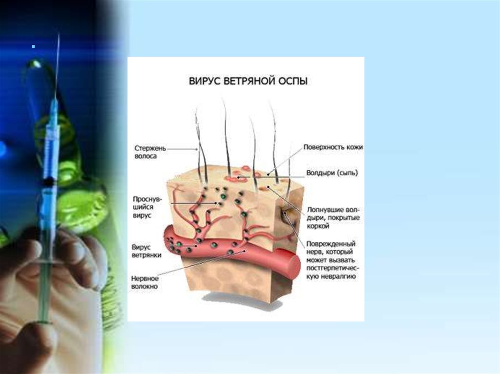 Анамнез ветряной оспы. Органотропность ветряной оспы. Ветряная оспа презентация.