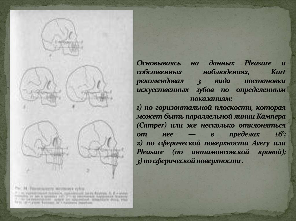 Постановка зубов по сферическим поверхностям презентация