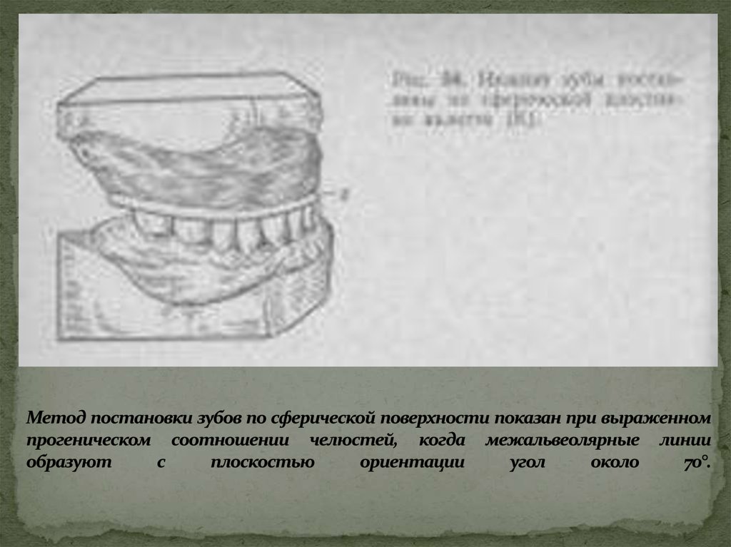 Постановка зубов по сферическим поверхностям презентация