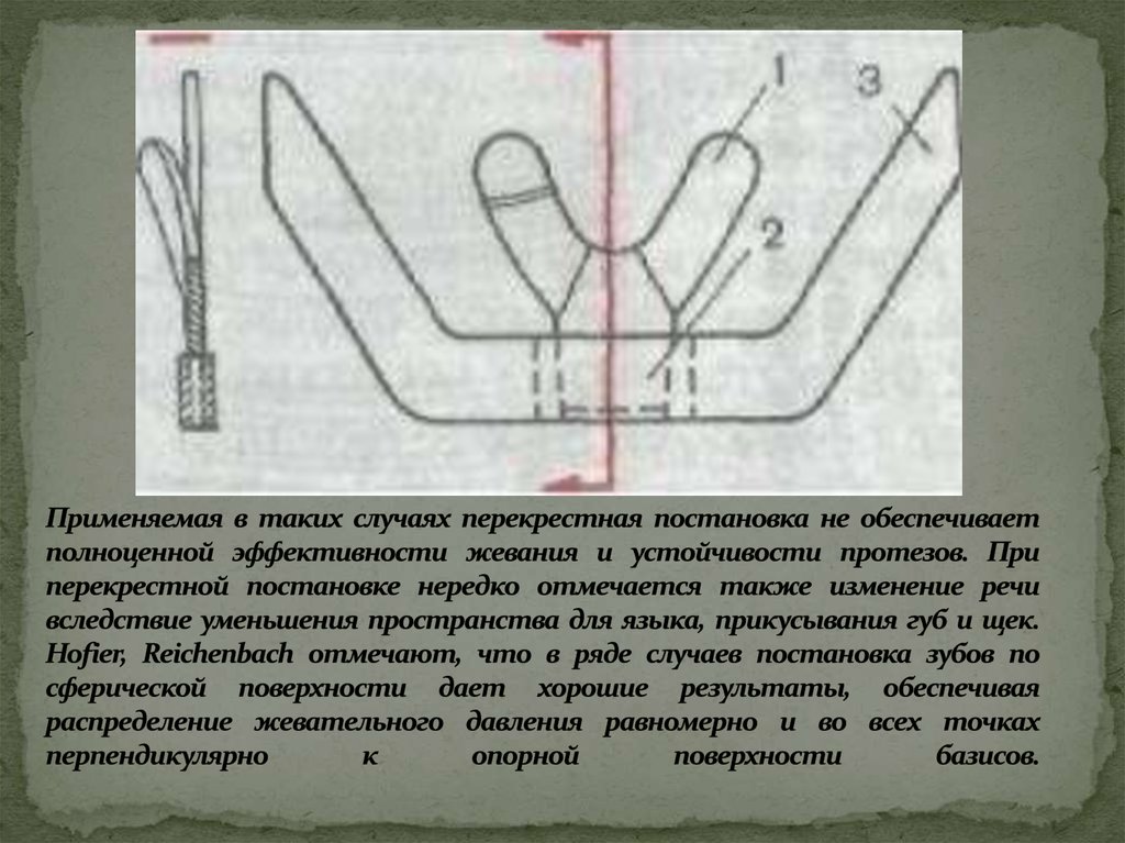 Применяемая в таких случаях перекрестная постановка не обеспечивает полноценной эффективности жевания и устойчивости протезов. При пере