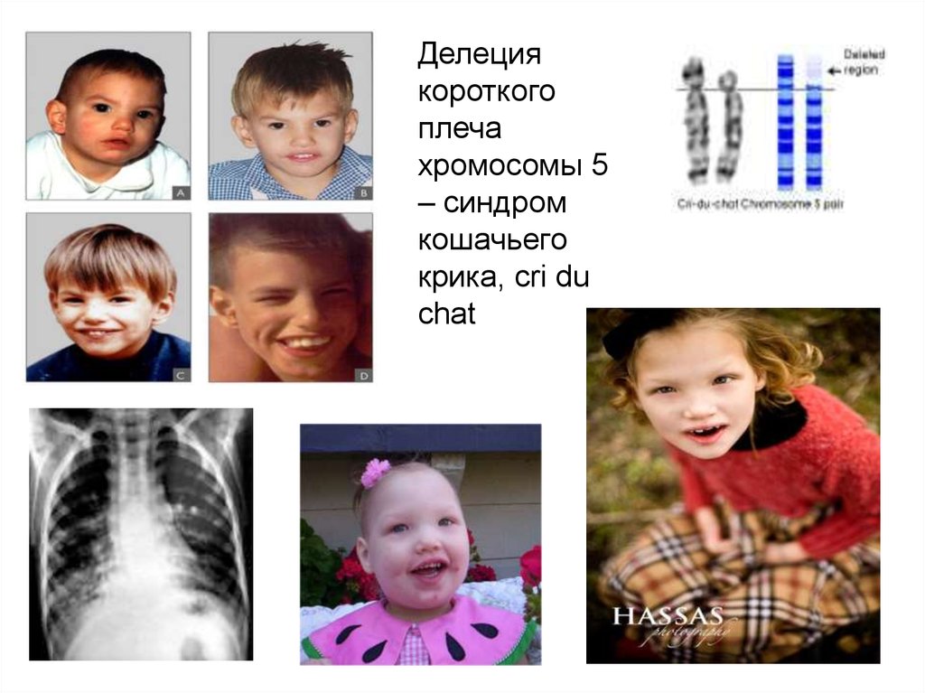 4 хромосома заболевание