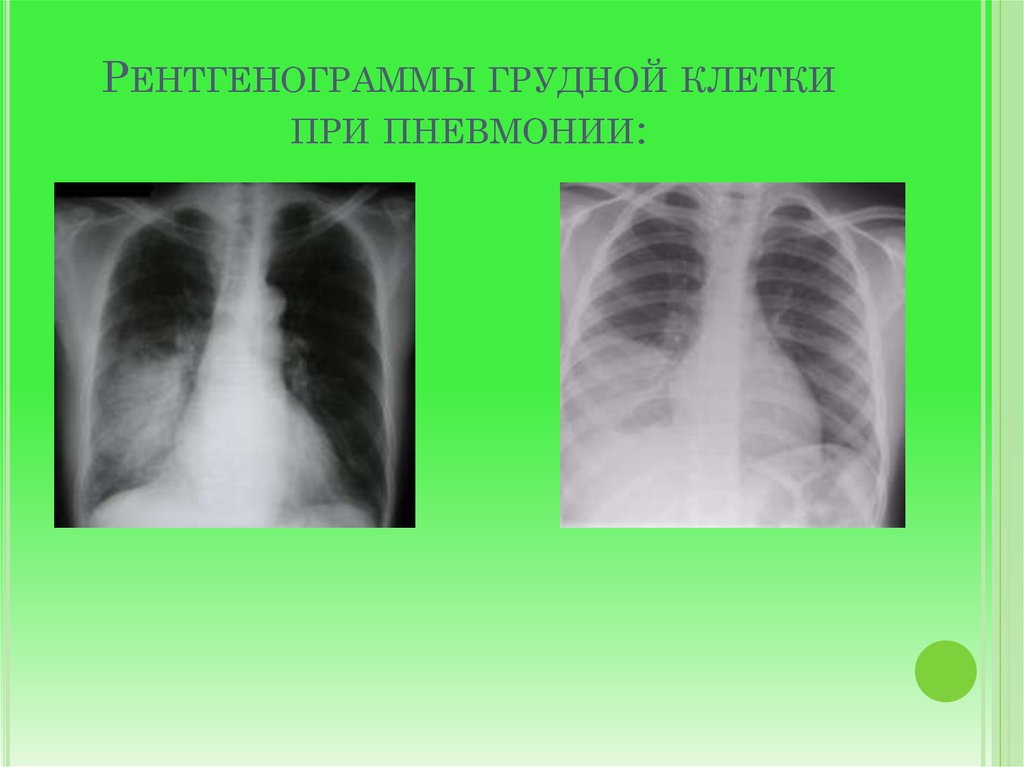 Что показывает рентген при кашле. Рентгенография грудной клетки односторонняя пневмония.