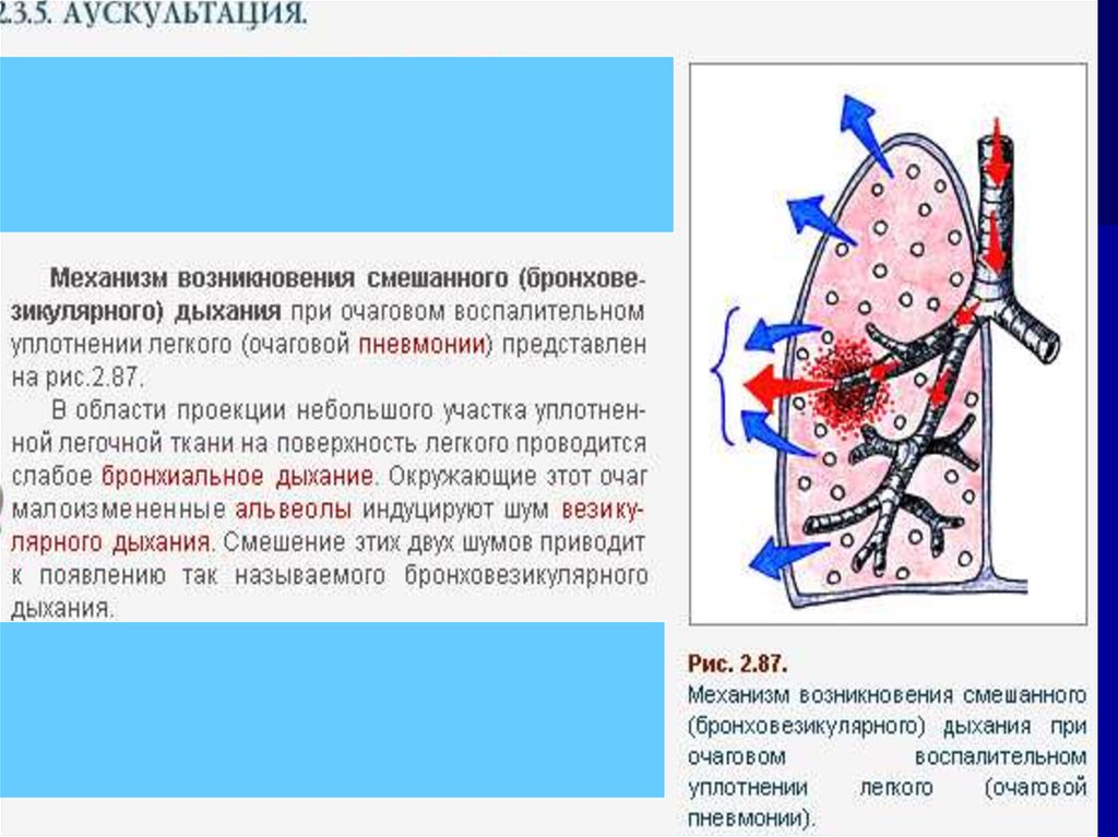 Виды дыхания при аускультации легких схема