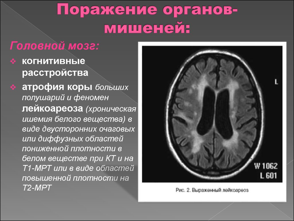 Мр картина множественных супратенториальных очагов хронической ишемии что это такое простыми словами