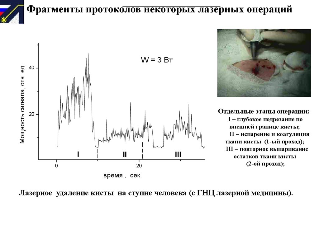 Операции фрагмента. Протокол лазерной операции. Лазерное испарение опухоли. Протоколы лечения лазером Quatra.