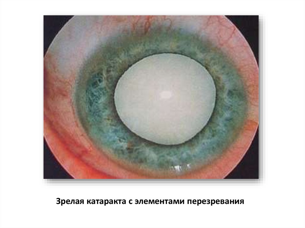 Начальная старческая катаракта. Незрелая сенильная катаракта. Врожденная зонулярная катаракта.