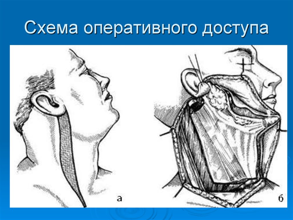 Операции на околоушной слюнной железы. Операции на околоушной слюнной железе. Воротникообразный разрез по Кохеру. Резекция околоушной слюнной железы. Субтотальная резекция околоушной железы.