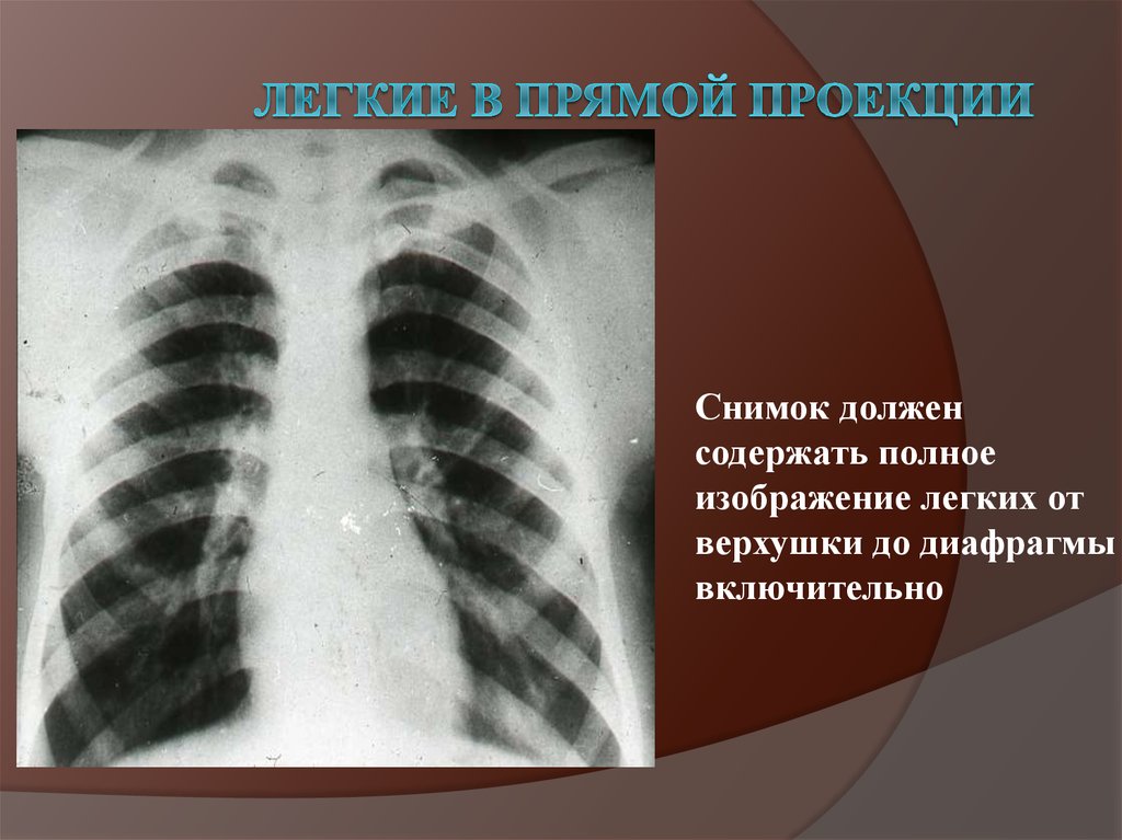 Легкие в прямой проекции