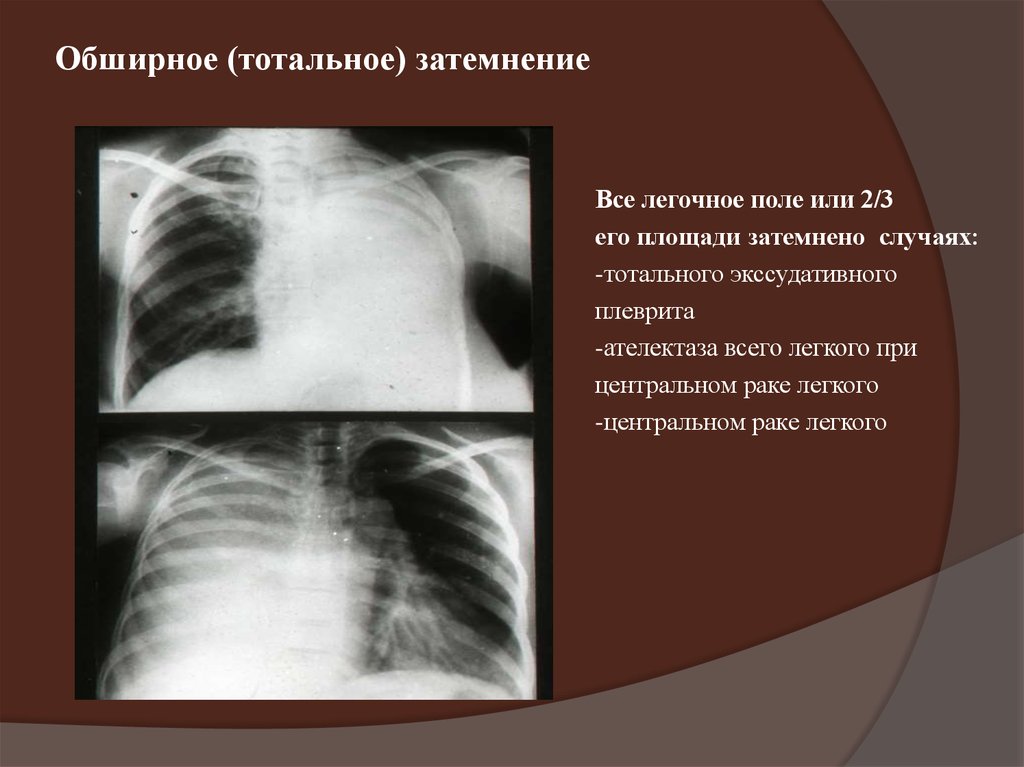 Поле легкого. Синдром затемнения легочного поля. Рентген тотальное затемнение легкого. Синдром тотального затемнения легочного поля. Тотальный ателектаз легкого на рентгене.