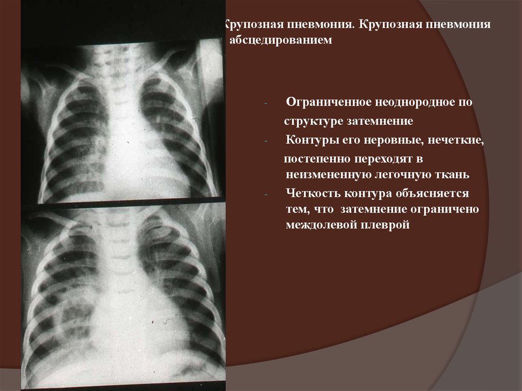 Крупозная пневмония. Крупозная пневмония рентгенограмма. Крупозная пневмония с абсцедированием. Крупозная пневмония рентген. Рентген КРУПОЗН пневмон.