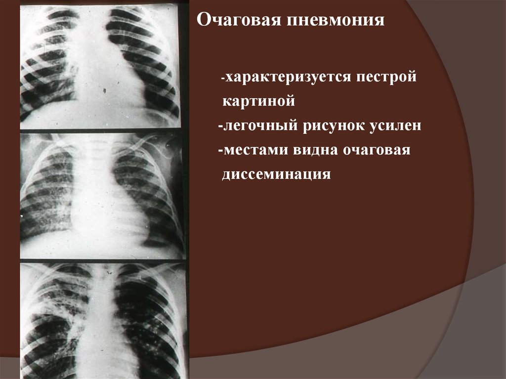 Осложнения очагов пневмонии. Очаговая пневмония. Очаговая пневмония характеризуется. Очаговая пневмония рентген. Очаговая пневмония пневмония.