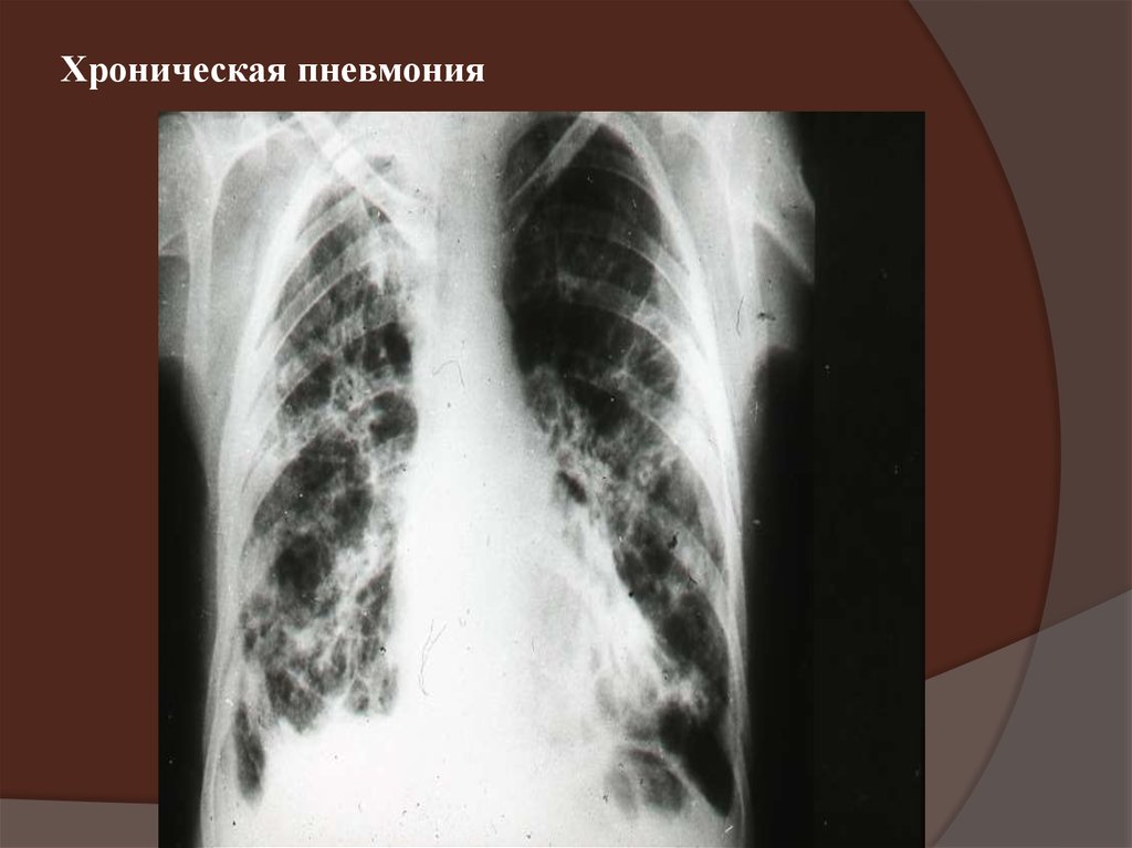 Картина пневмонии. Хроническая пневмония рентген. Затяжная пневмония рентген. Острое и хроническое воспаление легких на рентгене.