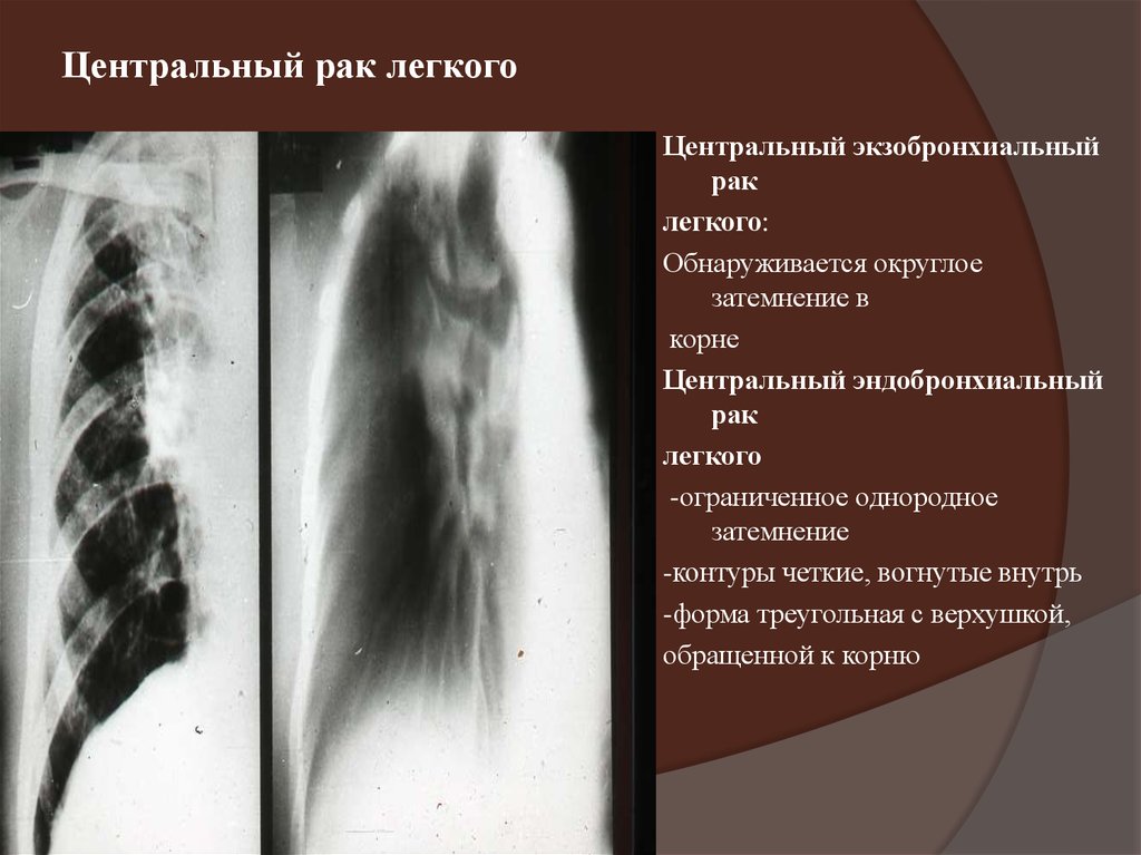 Центральный рак легкого презентация