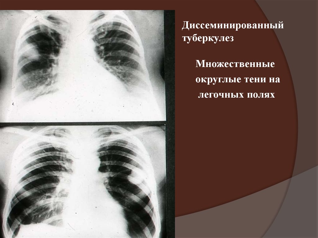 Формы диссеминированного туберкулеза. Диссеминированный туберкулёз лёгких рентген. Диссеминированный инфильтративный туберкулез. Подострый диссеминированный туберкулез рентген. Очаговый и диссеминированный туберкулез.