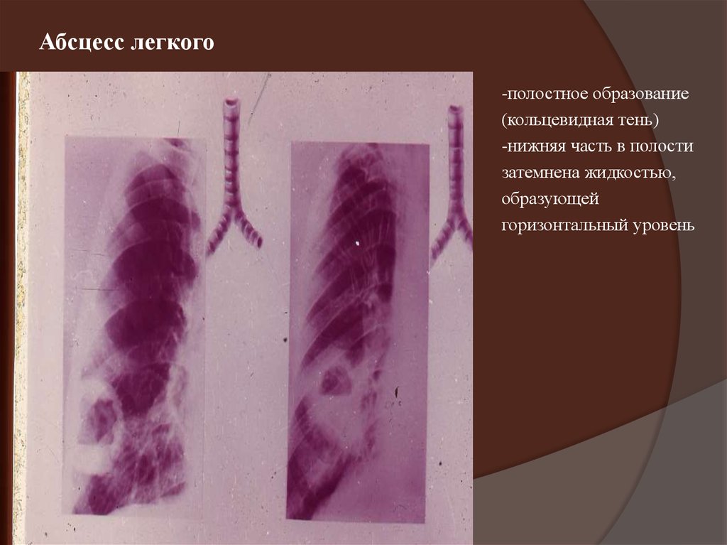 Абсцесс легкого презентация хирургия