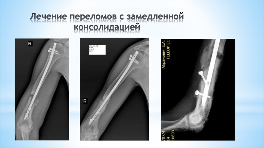 Замедленная консолидация презентация