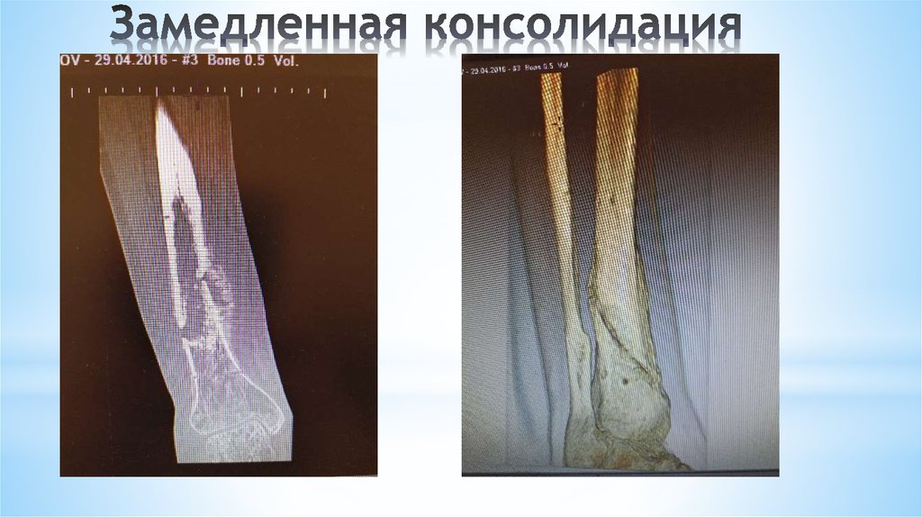 Периостальная костная мозоль. Замедленная консолидация переломов и ложные суставы. Замедленная консолидация несросшиеся переломы ложные суставы. Замедленная консолидация переломов рентген. Замедленная консолидация и ложный сустав.